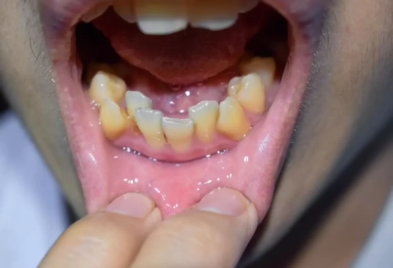 7 Common Ways People Stain Their Teeth