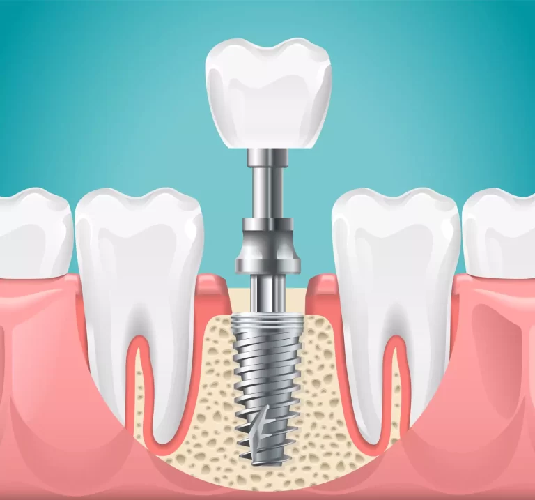 Benefits of Dental Implants